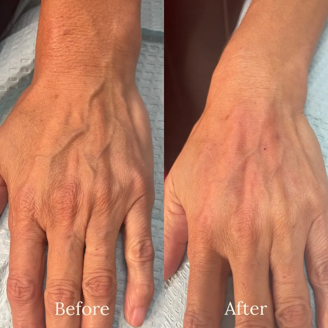 before and after hand rejuvenation treatment at RedLands Body Sculpting with Dr. Aya in California