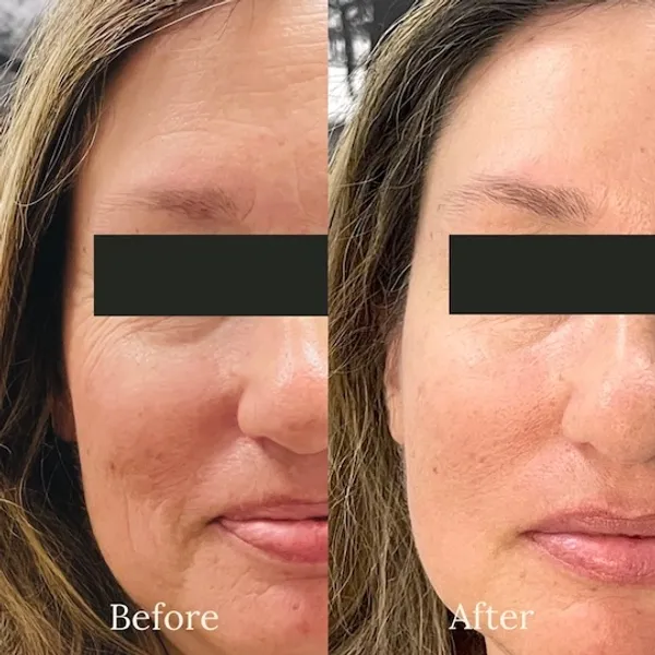 before and after tox booster treatment at RedLands Body Sculpting with Dr. Aya in California